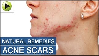 Skin Care - Acne Scars - Natural Ayurvedic Home Remedies